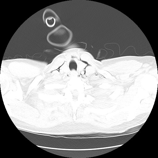 File:Boerhaave syndrome (Radiopaedia 59796-67310 Axial lung window 8).jpg