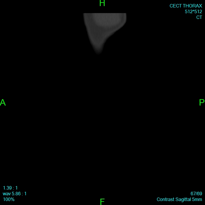 Bone metastases from lung carcinoma (Radiopaedia 54703-60937 Sagittal bone window 67).jpg