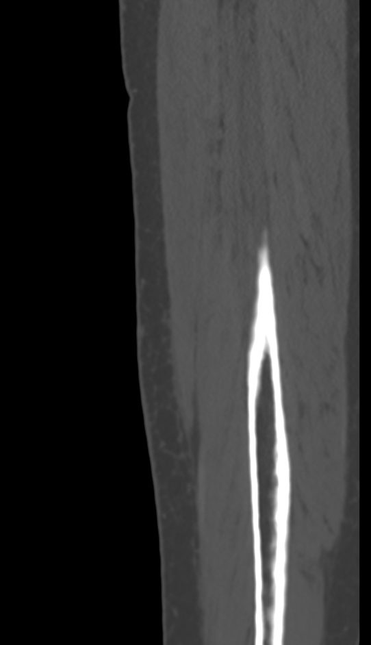 Bone metastasis - tibia (Radiopaedia 57665-64609 Sagittal bone window 157).jpg
