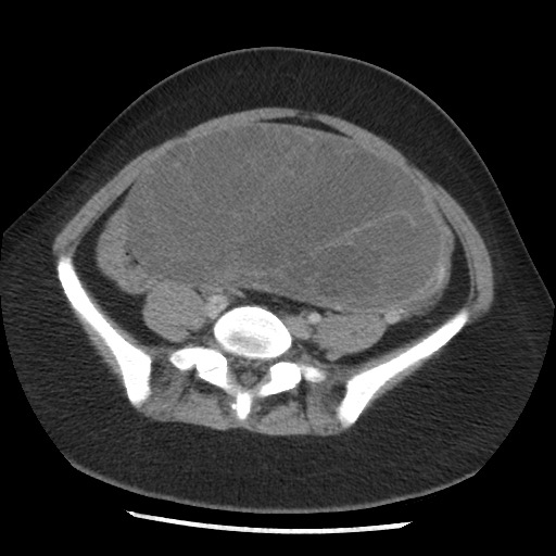 File:Borderline mucinous tumor (ovary) (Radiopaedia 78228-90808 A 109).jpg