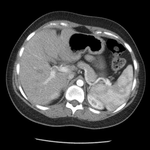 File:Borderline mucinous tumor (ovary) (Radiopaedia 78228-90808 A 45).jpg