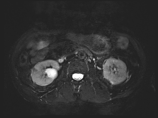 File:Bouveret syndrome (Radiopaedia 61017-68856 Axial MRCP 37).jpg
