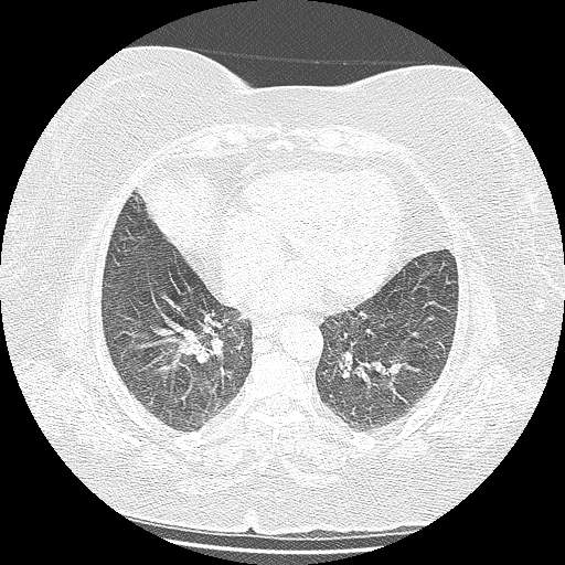 Bovine aortic arch - right internal mammary vein drains into the superior vena cava (Radiopaedia 63296-71875 Axial lung window 109).jpg