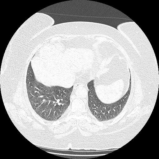 Bovine aortic arch - right internal mammary vein drains into the superior vena cava (Radiopaedia 63296-71875 Axial lung window 124).jpg