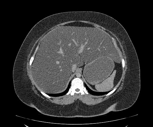 Bowel and splenic infarcts in acute lymphocytic leukemia (Radiopaedia 61055-68913 A 36).jpg