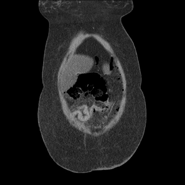 File:Bowel and splenic infarcts in acute lymphocytic leukemia (Radiopaedia 61055-68915 B 11).jpg