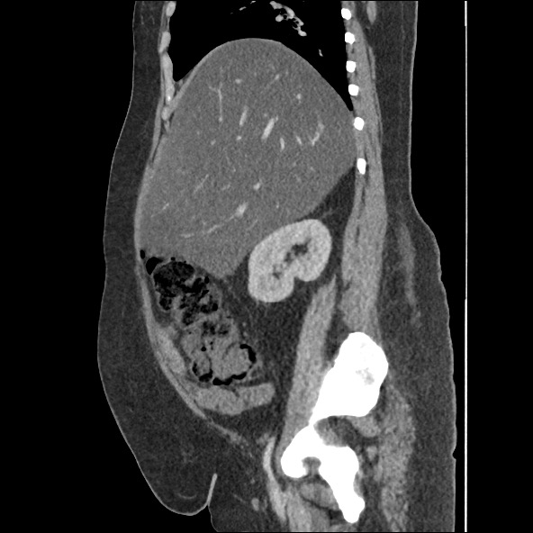 Bowel and splenic infarcts in acute lymphocytic leukemia (Radiopaedia 61055-68915 C 46).jpg