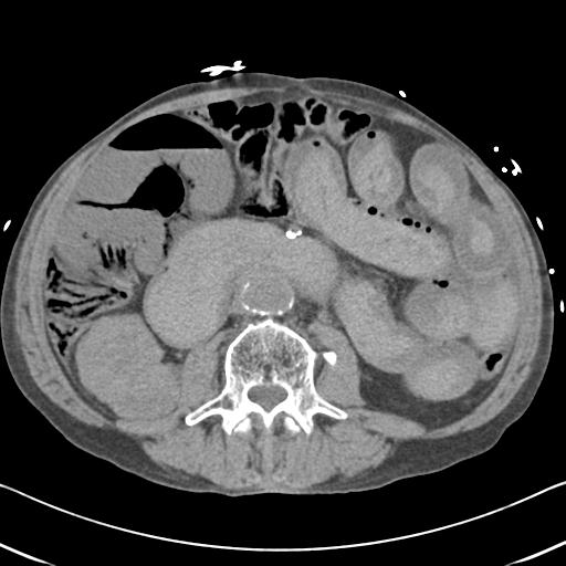 Bowel infarction (Radiopaedia 30296-30933 Axial non-contrast 40).jpg
