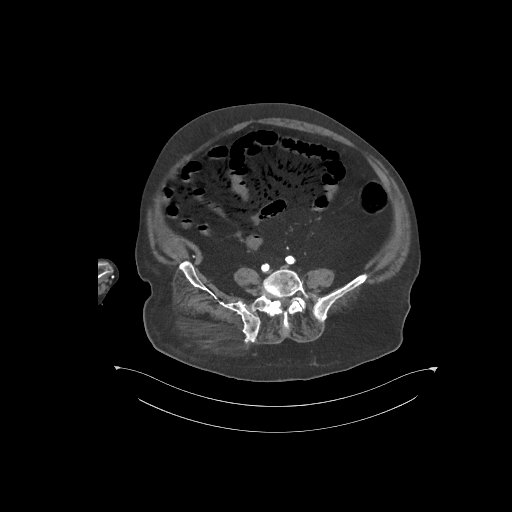 File:Bowel ischemia secondary to SMA occlusion with extensive portomesenteric venous gas (Radiopaedia 54656-60871 A 19).jpg