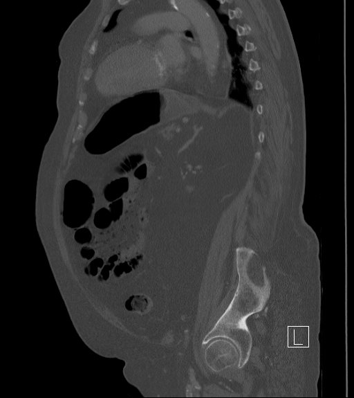 Bowel ischemia secondary to SMA occlusion with extensive portomesenteric venous gas (Radiopaedia 54656-60871 Sagittal bone window 36).jpg