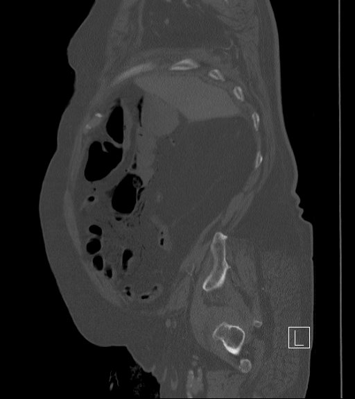 Bowel ischemia secondary to SMA occlusion with extensive portomesenteric venous gas (Radiopaedia 54656-60871 Sagittal bone window 94).jpg