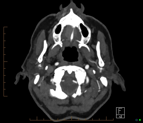 Brachiocephalic trunk stenosis (Radiopaedia 87242-103519 A 66).jpg