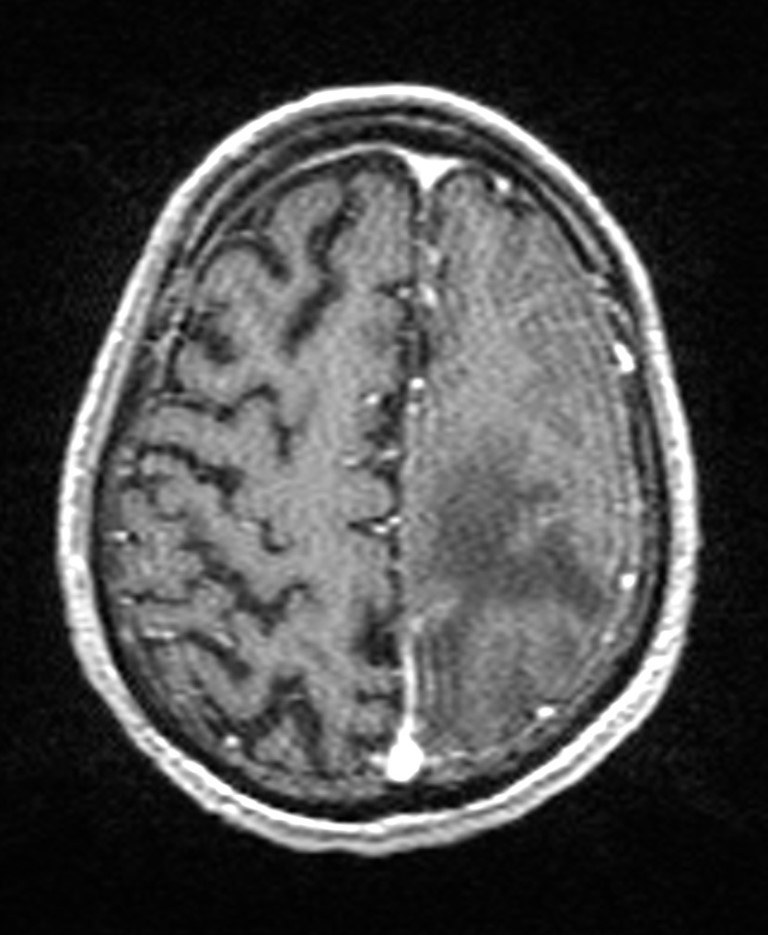Brain abscess with dual rim sign (Radiopaedia 87566-103938 Axial T1 C+ 126).jpg