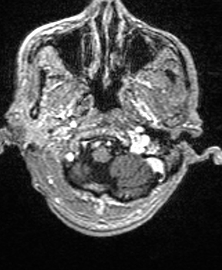 Brain abscess with dual rim sign (Radiopaedia 87566-103938 Axial T1 C+ 25).jpg