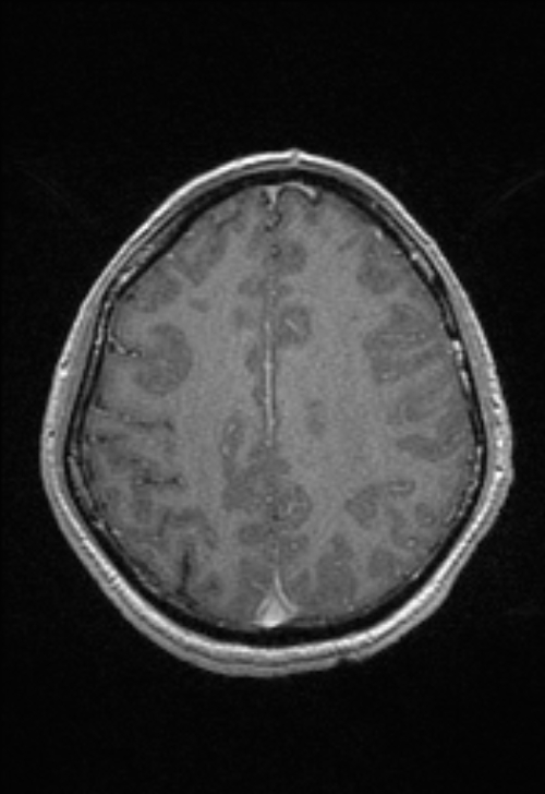 Brain abscess with ventriculitis (Radiopaedia 85703-101495 Axial T1 C+ 127).jpg