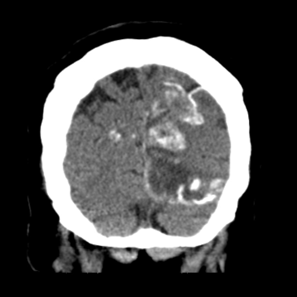 Brain cortical laminar necrosis (Radiopaedia 25822-25971 C 47).jpg