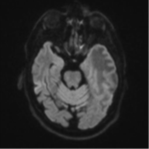Brain metastasis (large cystic mass) (Radiopaedia 47497-52107 Axial DWI 37).png