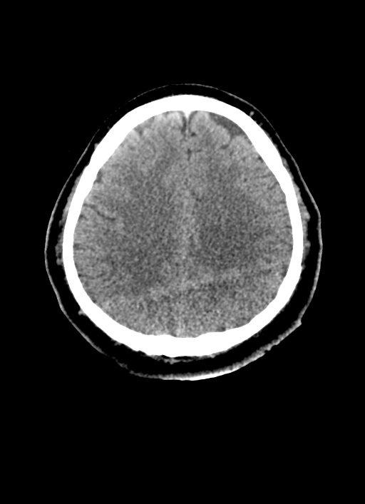 Brainstem hemorrhage (Radiopaedia 81294-94976 Axial non-contrast 21).jpg