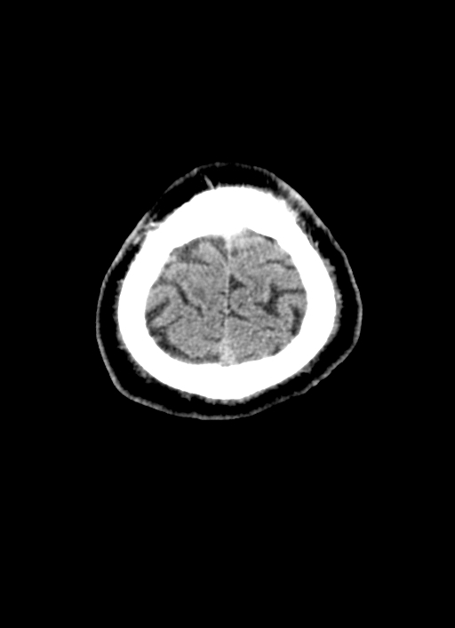 Brainstem hemorrhage (Radiopaedia 81294-94976 Axial non-contrast 8).jpg