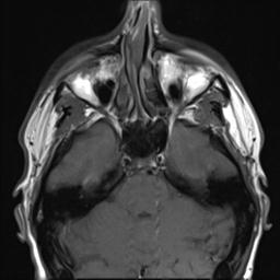 File:Branchial cleft cyst (Radiopaedia 31167-31876 Axial T1 31).jpg