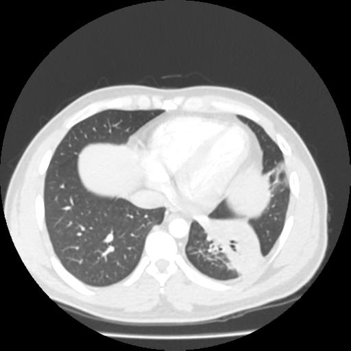 File:Bronchial carcinoid (Radiopaedia 80013-93291 Axial lung window 94).jpg