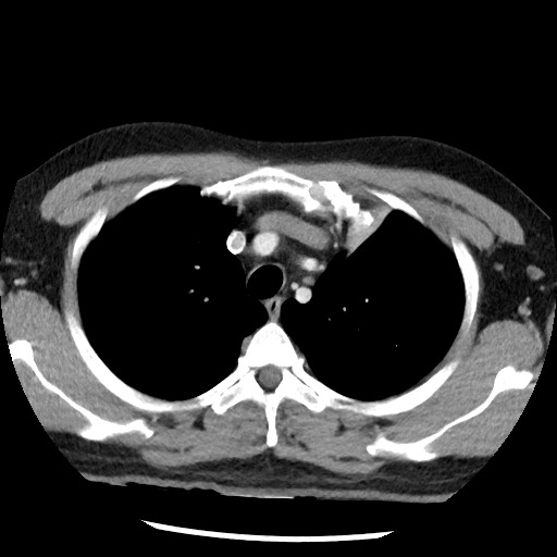 Bronchial carcinoid tumor (Radiopaedia 67377-76764 A 17).jpg