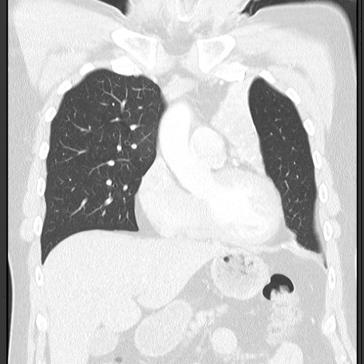 Bronchial carcinoid tumor (Radiopaedia 67377-76764 Coronal lung window 28).jpg