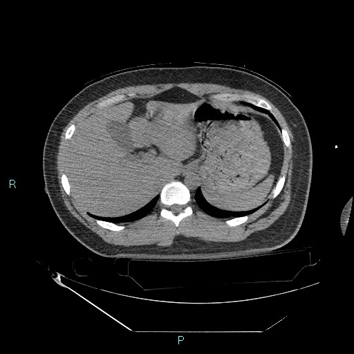 Bronchial carcinoid tumor (Radiopaedia 78272-90870 Axial non-contrast 100).jpg