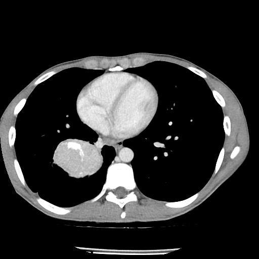 Bronchial carcinoid tumor causing right lower lobe collapse (Radiopaedia 83495-98594 A 34).jpg