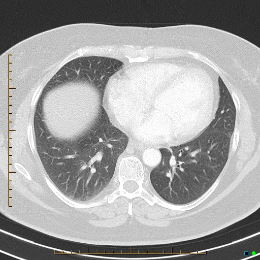 Bronchial diverticula (Radiopaedia 79512-92675 Axial lung window 32).jpg