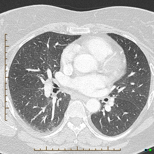 Bronchial diverticula (Radiopaedia 79512-92676 Axial lung window 100).jpg