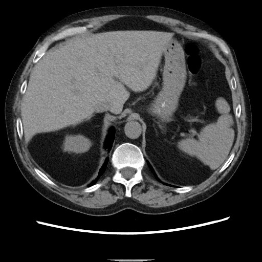 Bronchial stenosis - lung transplant (Radiopaedia 73133-83848 Axial non-contrast 56).jpg