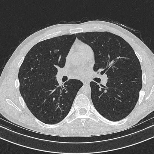 Bronchocele (Radiopaedia 60676-68429 Axial lung window 35).jpg