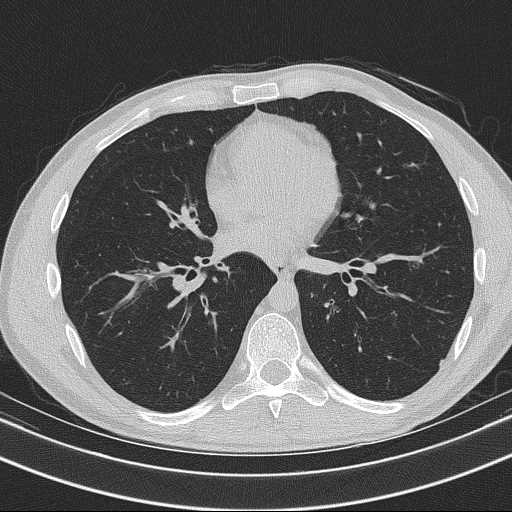 Bronchocele (Radiopaedia 60676-68429 Axial lung window 42).jpg