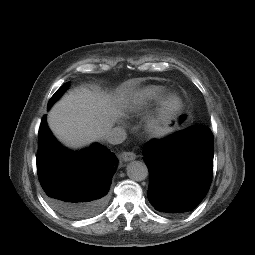 Bronchogenic carcinoma with metastatic lymphadenopathy (Radiopaedia 37671-39569 Axial non-contrast 43).jpg