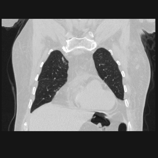File:Bronchogenic carcinoma with metastatic lymphadenopathy (Radiopaedia 37671-39569 Coronal lung window 12).jpg