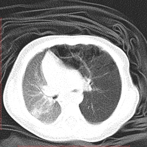 Bronchogenic cyst (Radiopaedia 78599-91409 Axial lung window 64).jpg