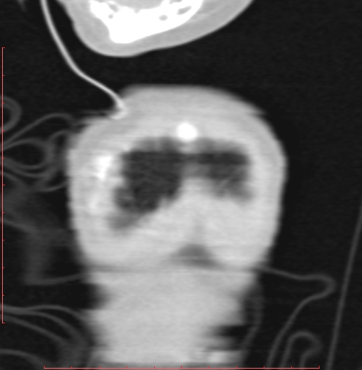 Bronchogenic cyst (Radiopaedia 78599-91409 Coronal lung window 6).jpg