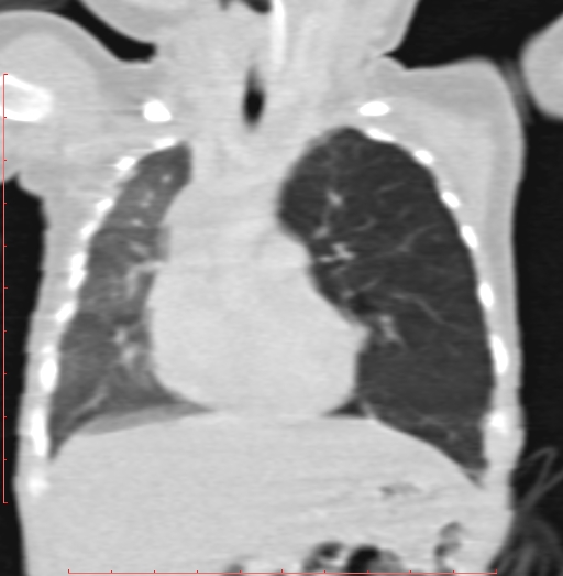 Bronchogenic cyst (Radiopaedia 78599-91409 Coronal lung window 97).jpg