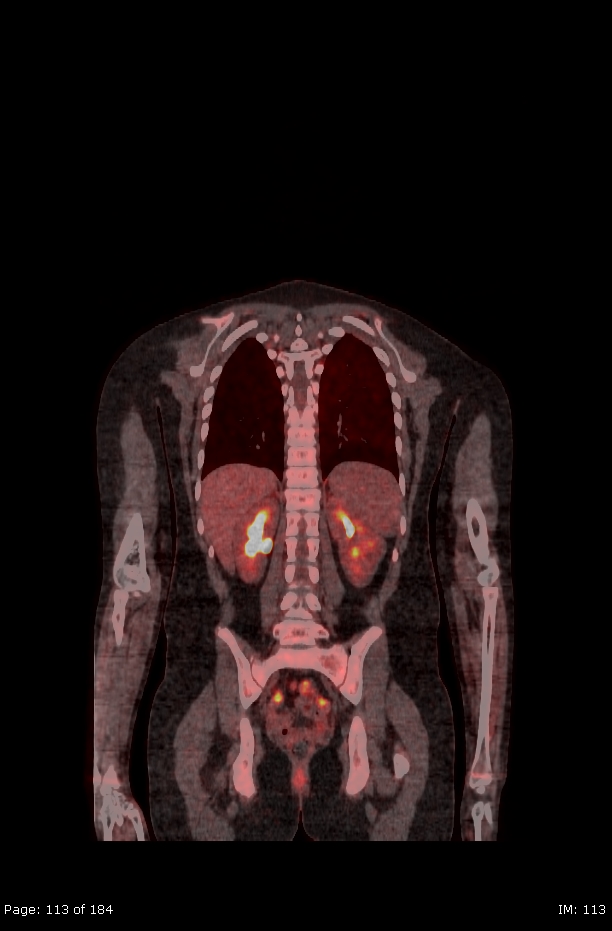 Brown fat uptake (FDG PET-CT) (Radiopaedia 77392-89513 Fused coronal 71).jpg