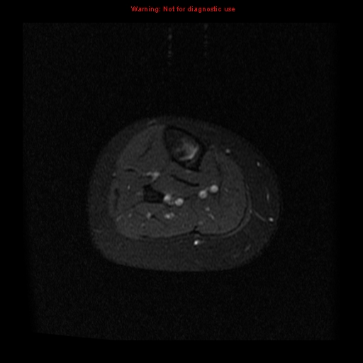 File:Brown tumor (Radiopaedia 12318-12597 Axial T1 C+ fat sat 31).jpg