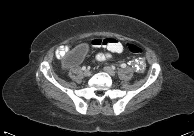 Brown tumors compressing the spinal cord (Radiopaedia 68442-77988 E 90).jpg