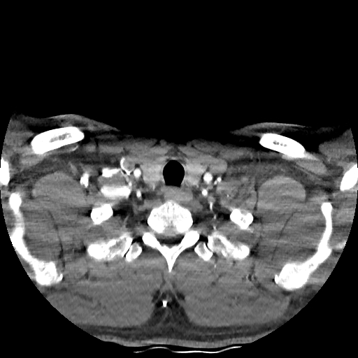 Buccal fat pad arteriovenous malformation (Radiopaedia 70936-81144 D 51).jpg