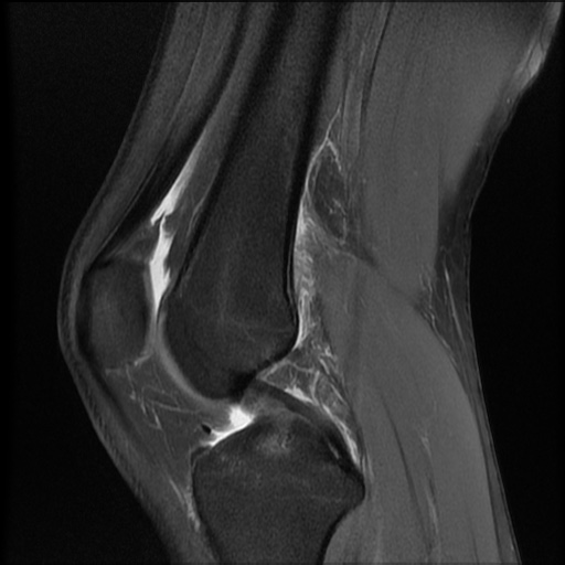 File:Bucket-handle meniscus tear (Radiopaedia 65700-74809 Sagittal PD fat sat 11).jpg