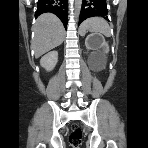 Burned-out testicular seminoma - retroperitoneal nodal metastases (Radiopaedia 62872-71245 B 48).jpg