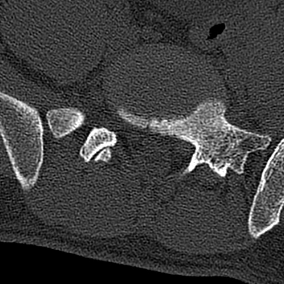 Burst fracture (Radiopaedia 53373-59357 Axial bone window 66).jpg