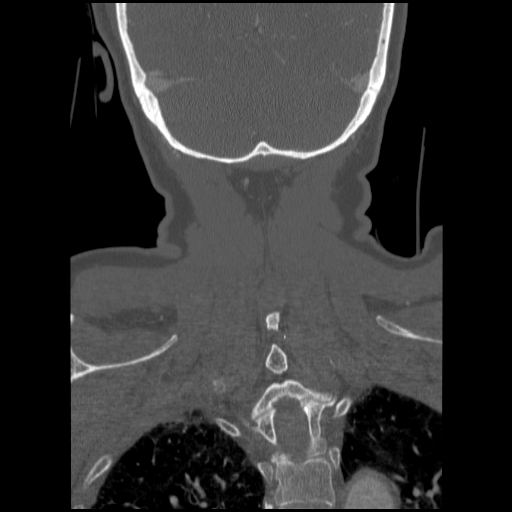File:C1 anterior arch (plough) fracture - type 1 (Radiopaedia 76181-87720 Coronal bone window 13).jpg