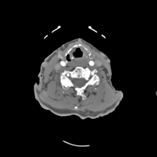 C2 fracture with vertebral artery dissection (Radiopaedia 37378-39200 A 115).png