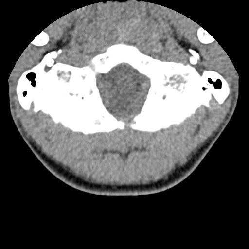 File:C5 facet fracture (Radiopaedia 58374-65499 Axial non-contrast 6).jpg
