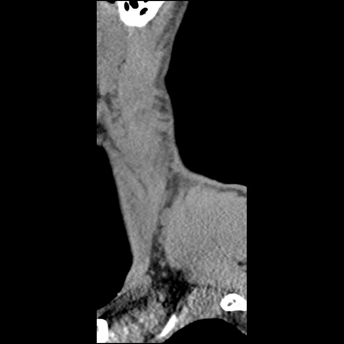 C5 facet fracture (Radiopaedia 58374-65499 D 68).jpg